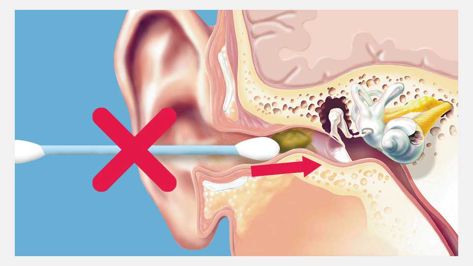 Billedet viser en vatpind inde i et øre.