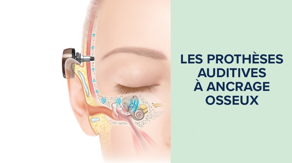 schéma de l'intérieur d'une oreille avec un ancrage osseux sur un visage