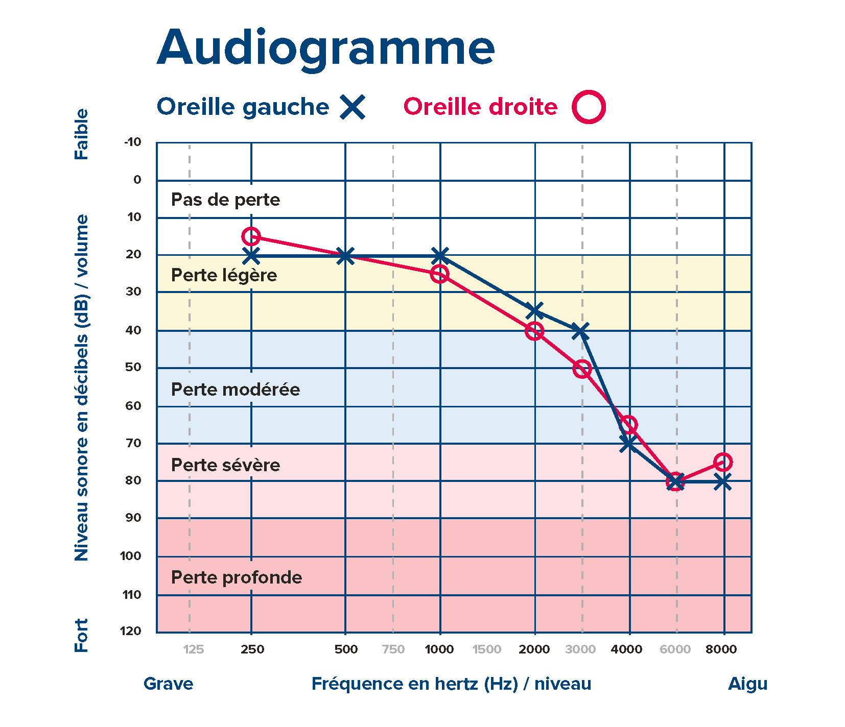 Comment lire un audiogramme obtenu après un bilan auditif