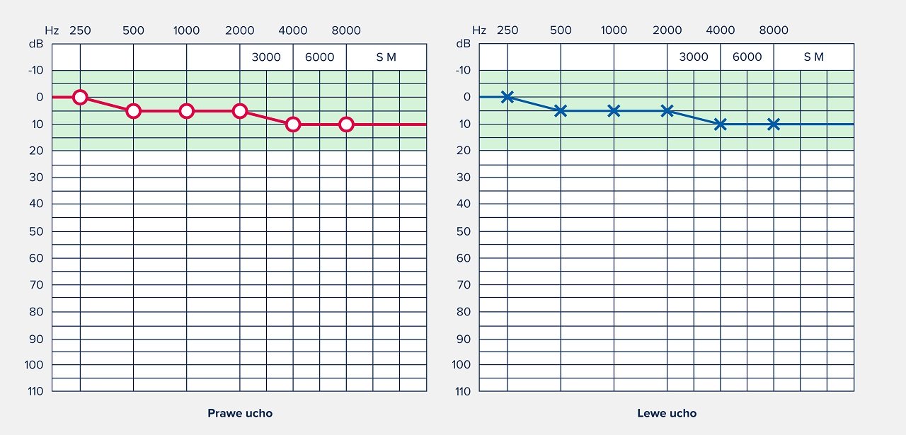 Audiometria tonalna – wyniki dla normy słuchowej.