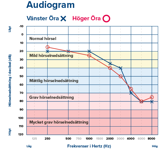 Bild på ett audiogram som visar olika grader av hörselnedsättning