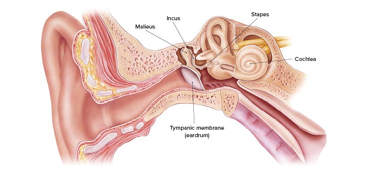 Image shows a ear with ear condition otosclerosis