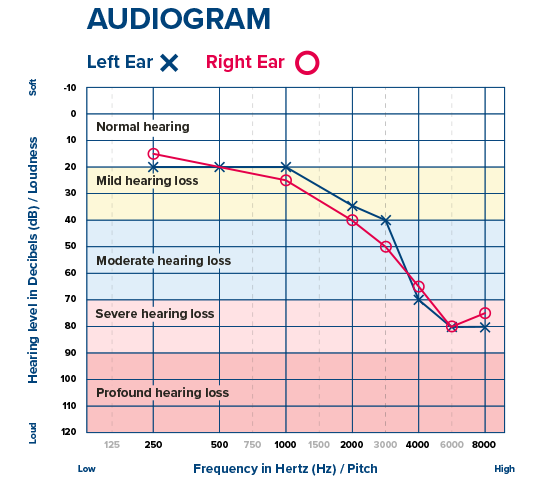 Understand The 4 Levels Of Hearing Loss [chart]